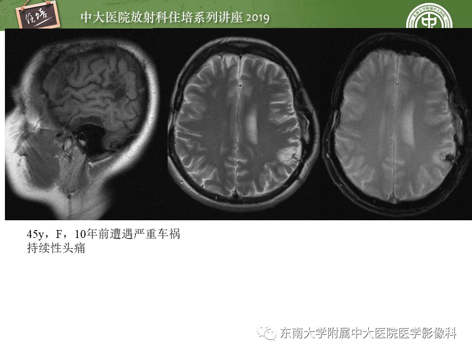 【PPT】成人颅脑损伤影像评估基本原则