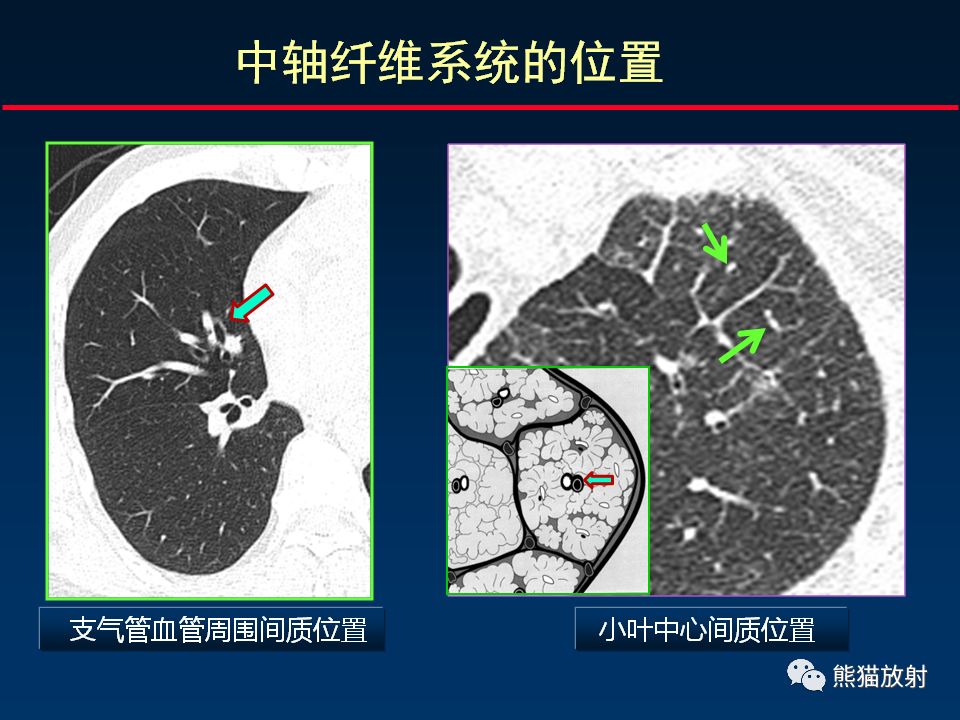 【PPT】正确判读肺间质改变的基本CT表现