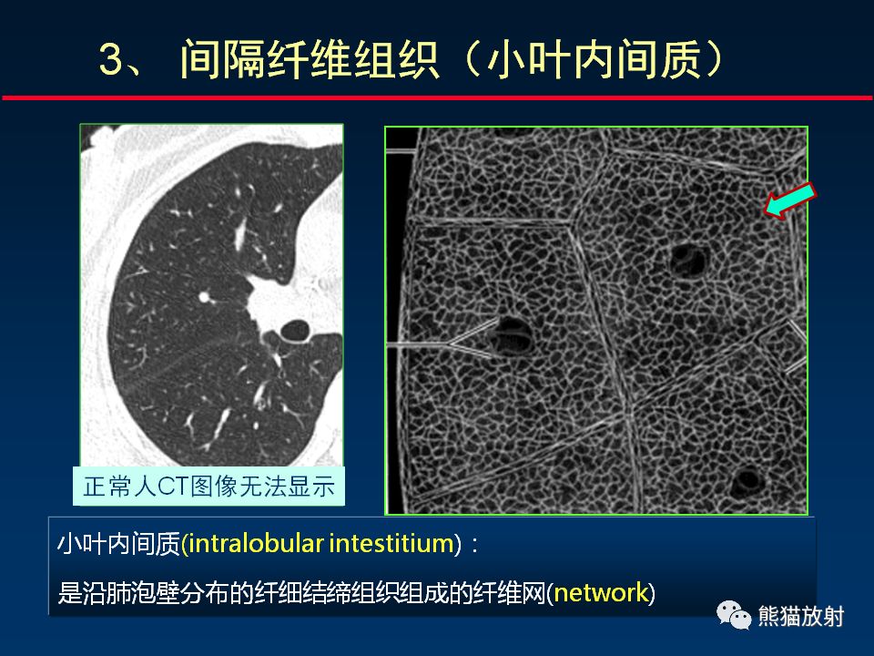 【PPT】正确判读肺间质改变的基本CT表现