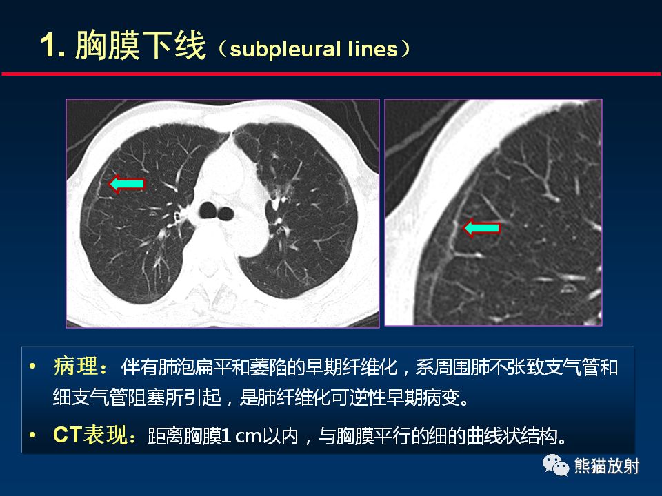 【PPT】正确判读肺间质改变的基本CT表现