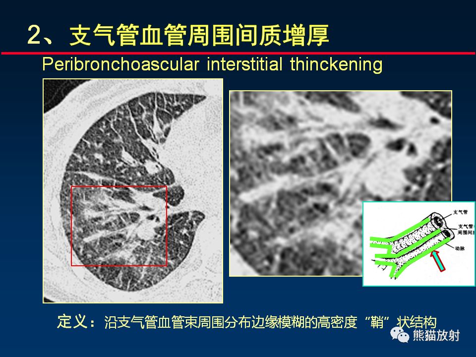 【PPT】正确判读肺间质改变的基本CT表现
