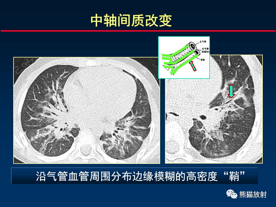 【PPT】正确判读肺间质改变的基本CT表现