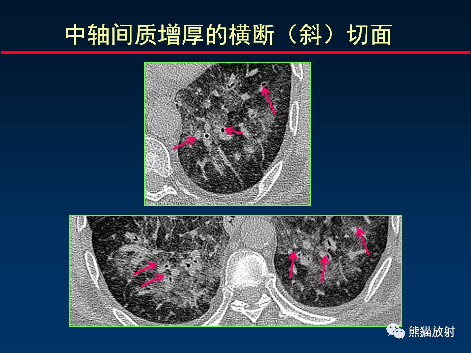 【PPT】正确判读肺间质改变的基本CT表现