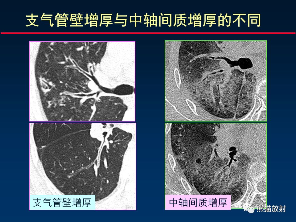 【PPT】正确判读肺间质改变的基本CT表现