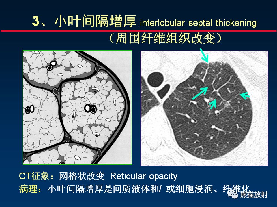 【PPT】正确判读肺间质改变的基本CT表现