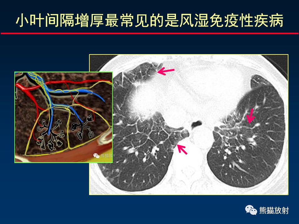 【PPT】正确判读肺间质改变的基本CT表现