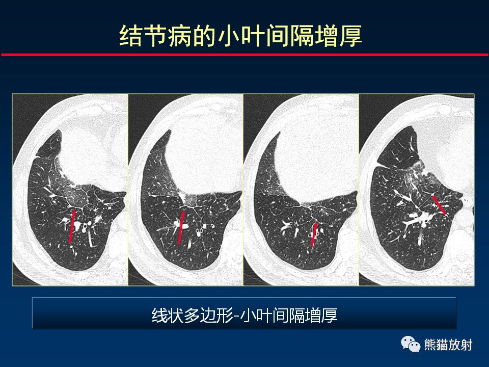 【PPT】正确判读肺间质改变的基本CT表现