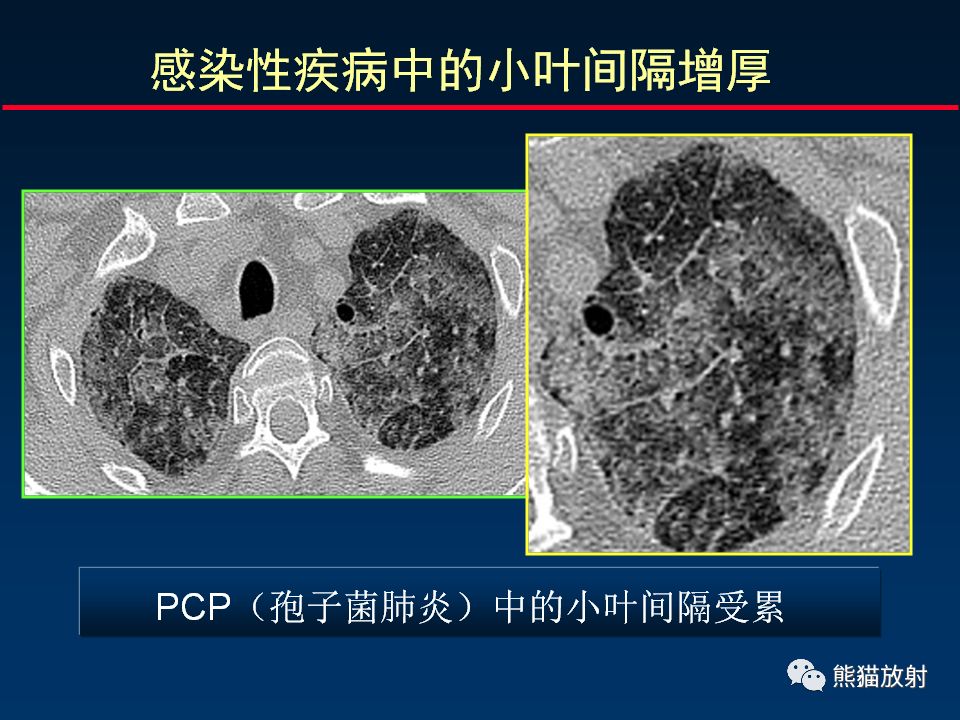 【PPT】正确判读肺间质改变的基本CT表现