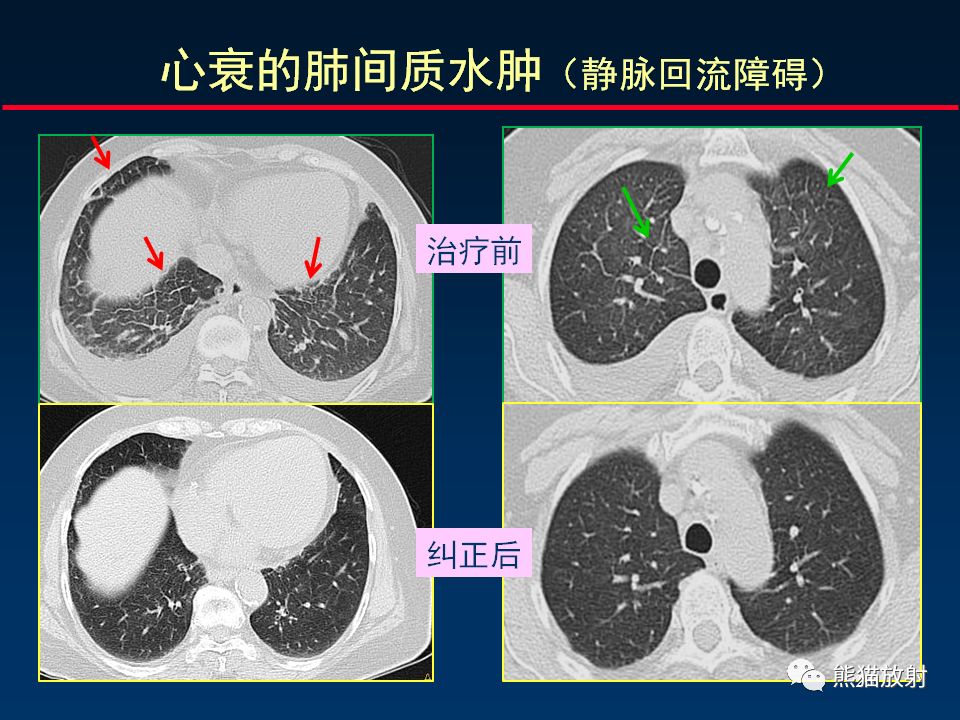 【PPT】正确判读肺间质改变的基本CT表现