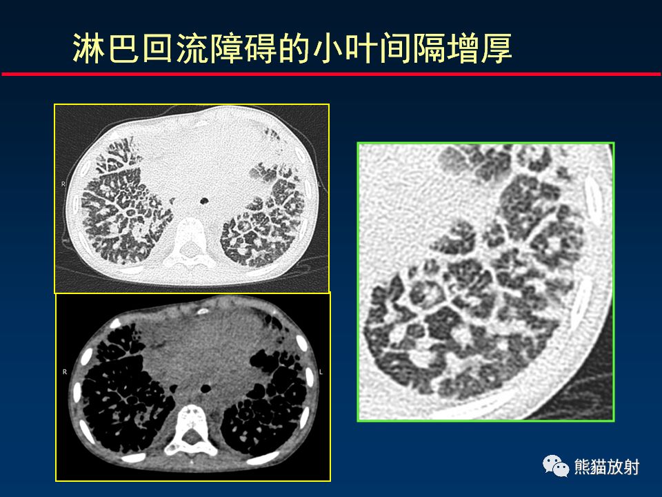 【PPT】正确判读肺间质改变的基本CT表现