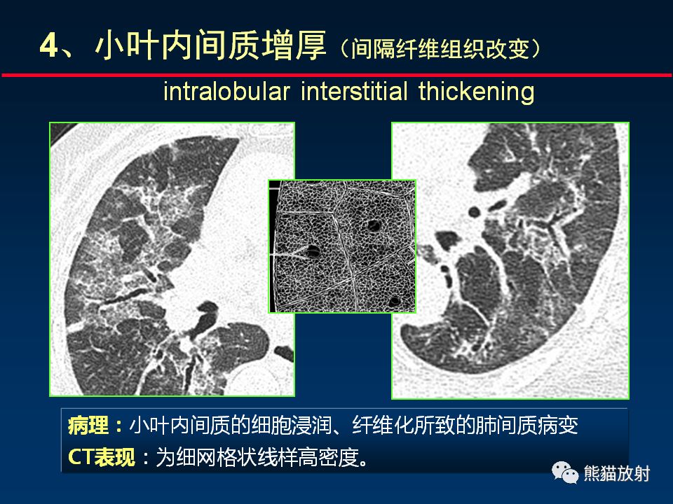【PPT】正确判读肺间质改变的基本CT表现