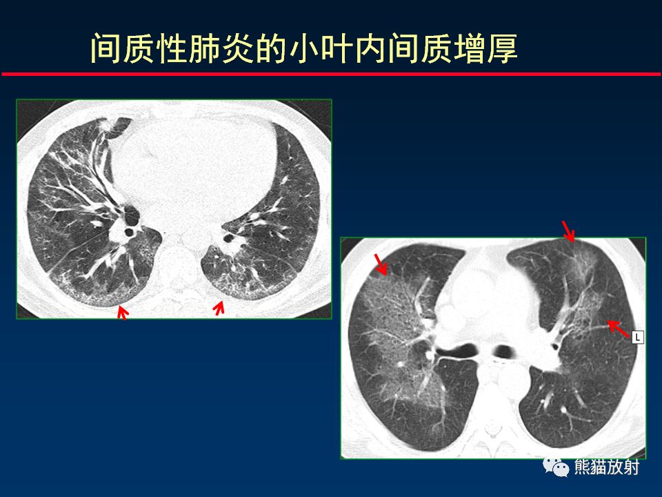 【PPT】正确判读肺间质改变的基本CT表现