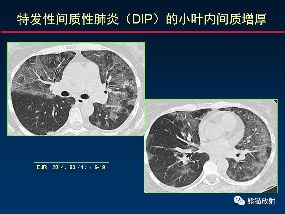 【PPT】正确判读肺间质改变的基本CT表现