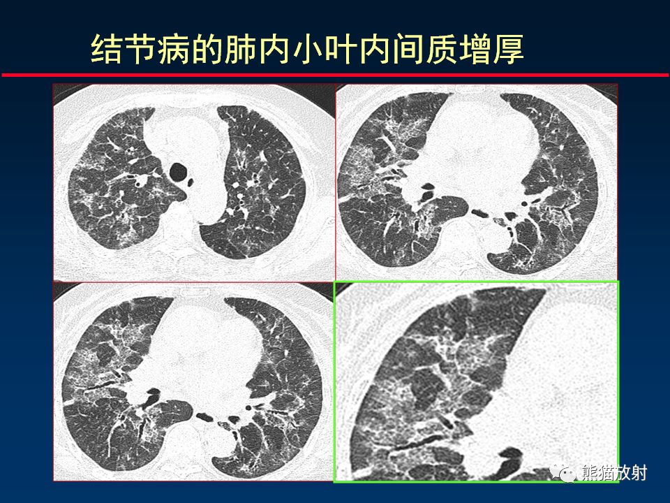 【PPT】正确判读肺间质改变的基本CT表现