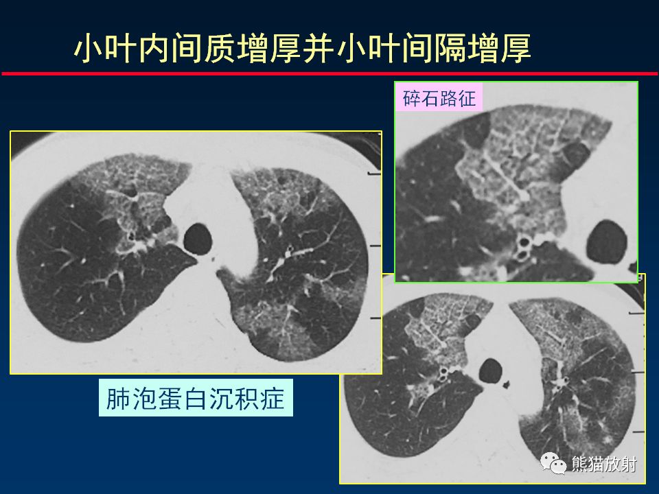 【PPT】正确判读肺间质改变的基本CT表现