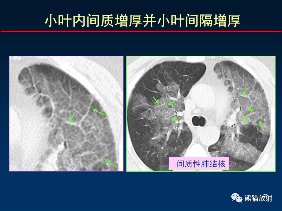 【PPT】正确判读肺间质改变的基本CT表现