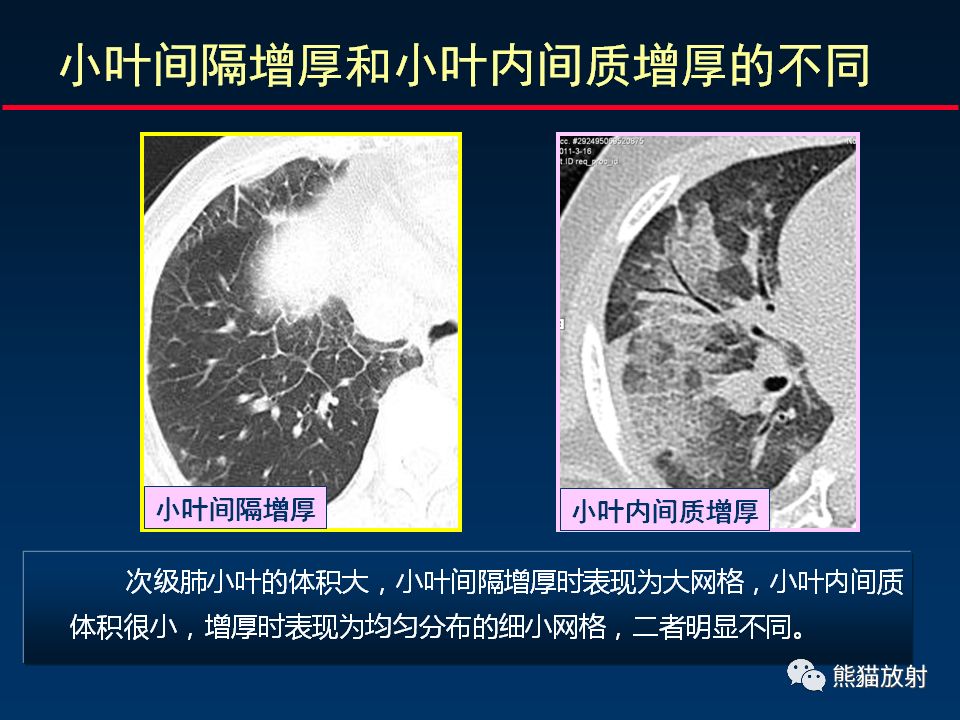 【PPT】正确判读肺间质改变的基本CT表现