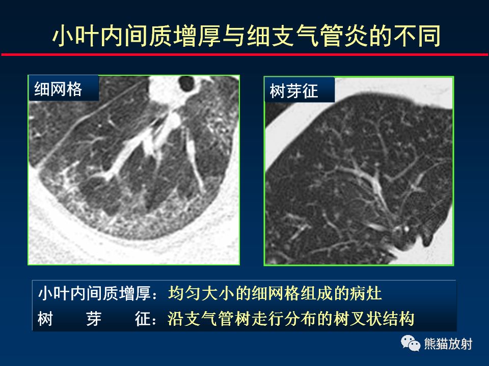 【PPT】正确判读肺间质改变的基本CT表现