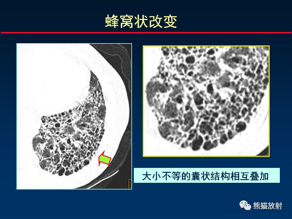 【PPT】正确判读肺间质改变的基本CT表现