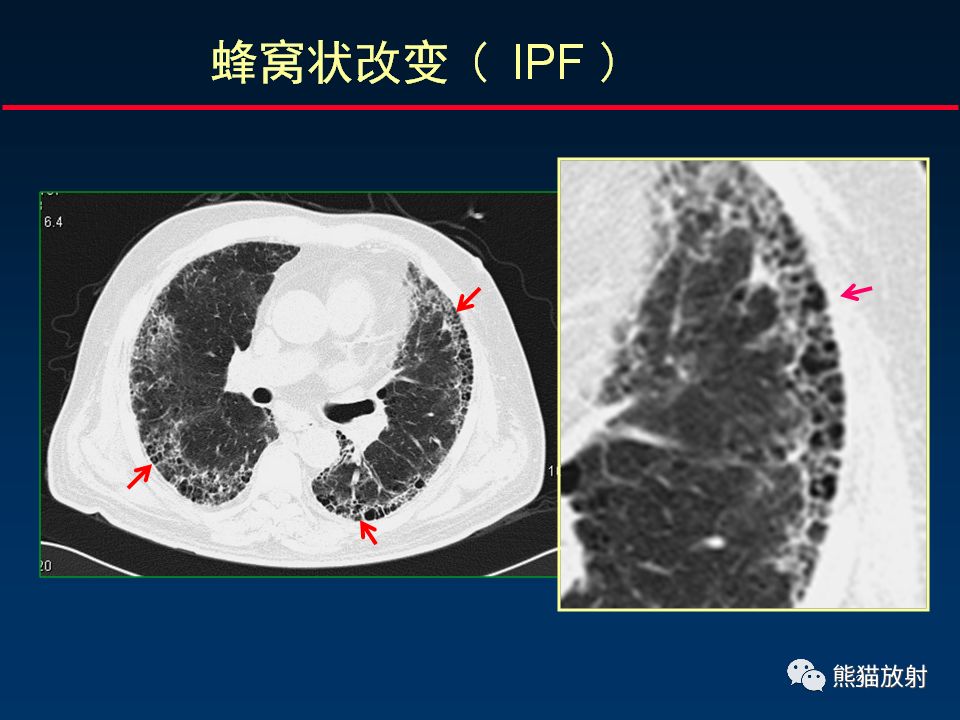 【PPT】正确判读肺间质改变的基本CT表现