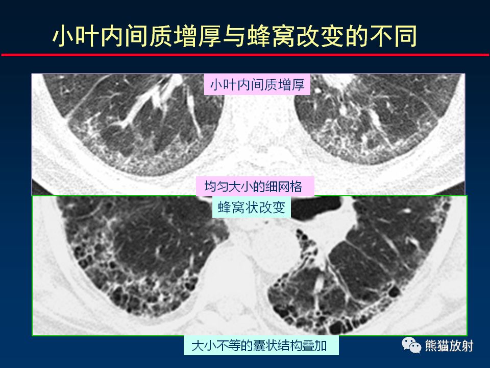 【PPT】正确判读肺间质改变的基本CT表现