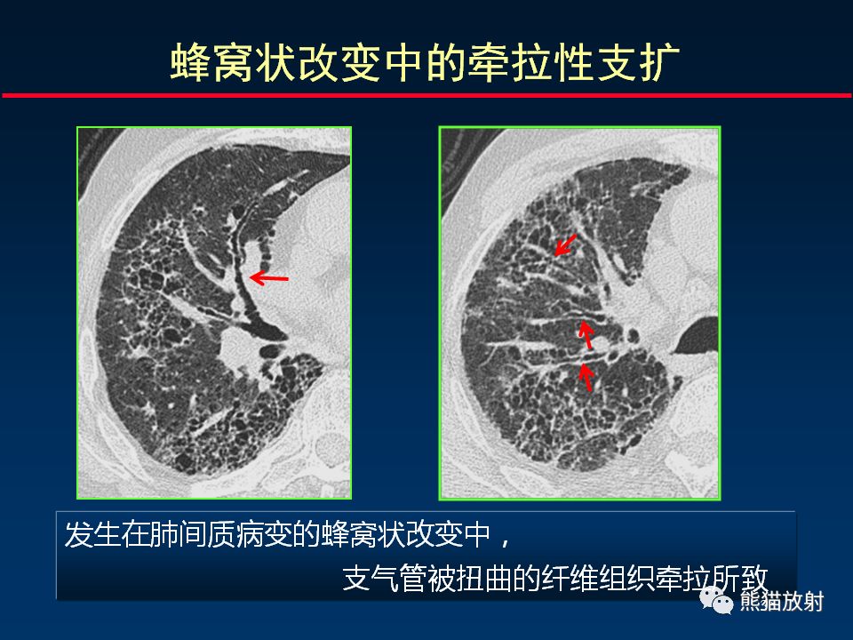 【PPT】正确判读肺间质改变的基本CT表现
