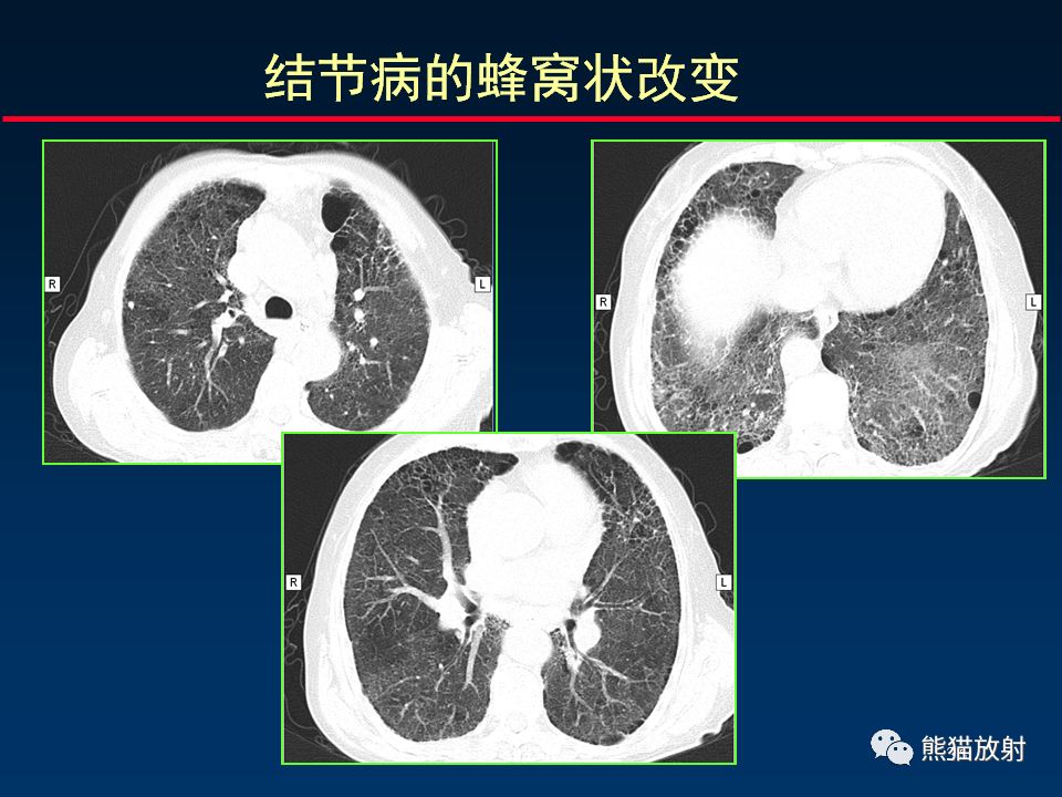 【PPT】正确判读肺间质改变的基本CT表现