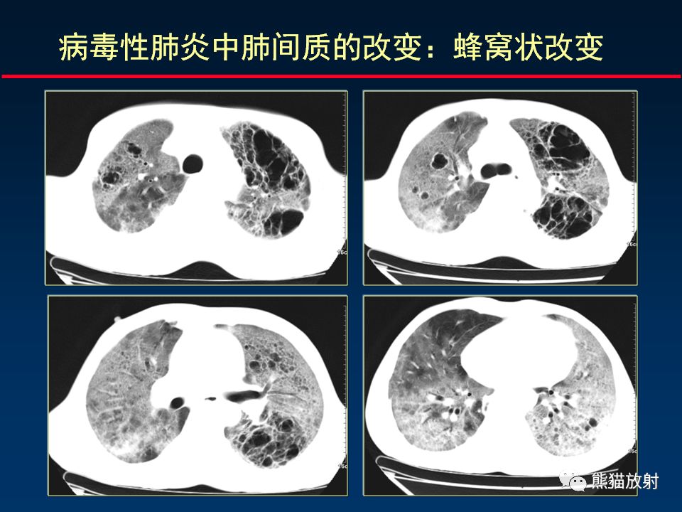 【PPT】正确判读肺间质改变的基本CT表现