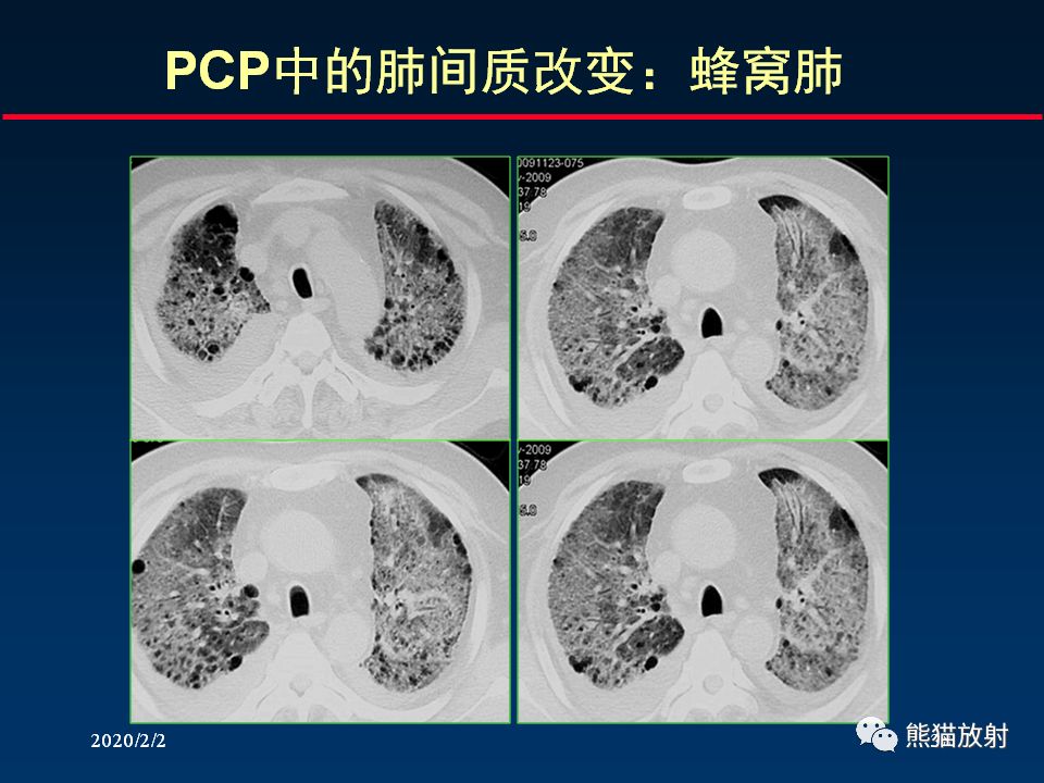 【PPT】正确判读肺间质改变的基本CT表现