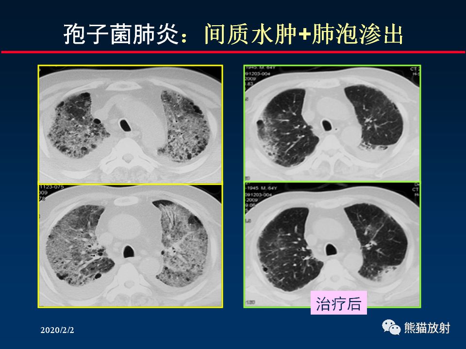 【PPT】正确判读肺间质改变的基本CT表现