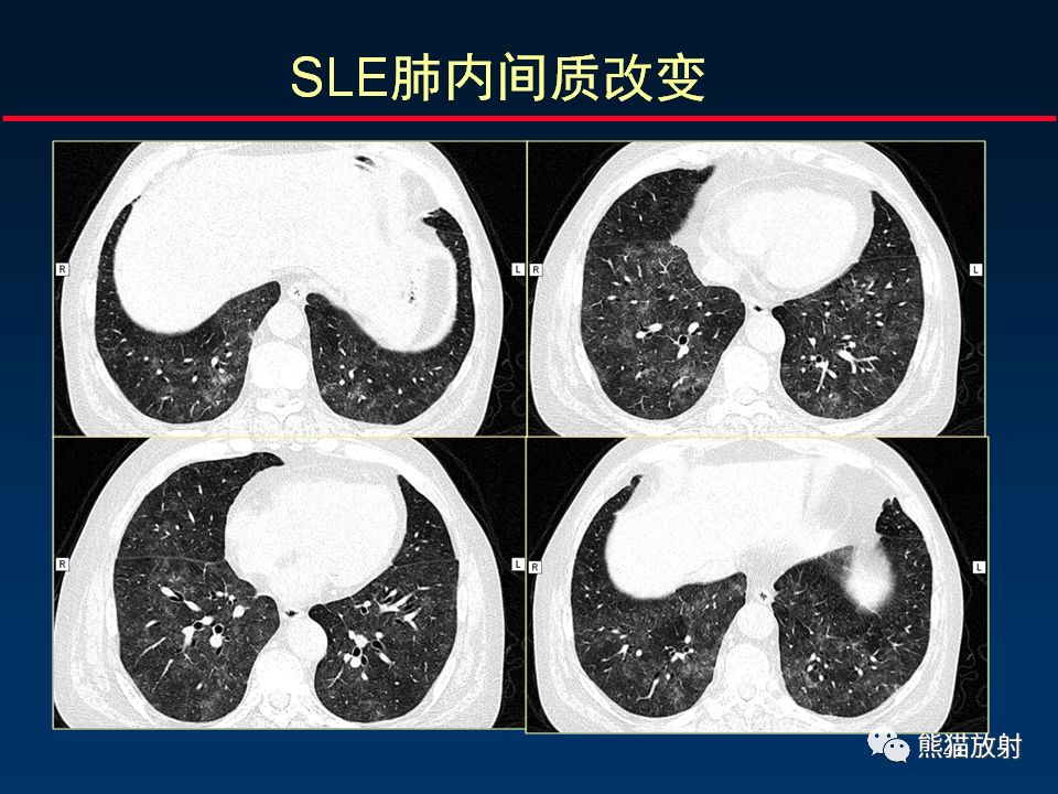 【PPT】正确判读肺间质改变的基本CT表现