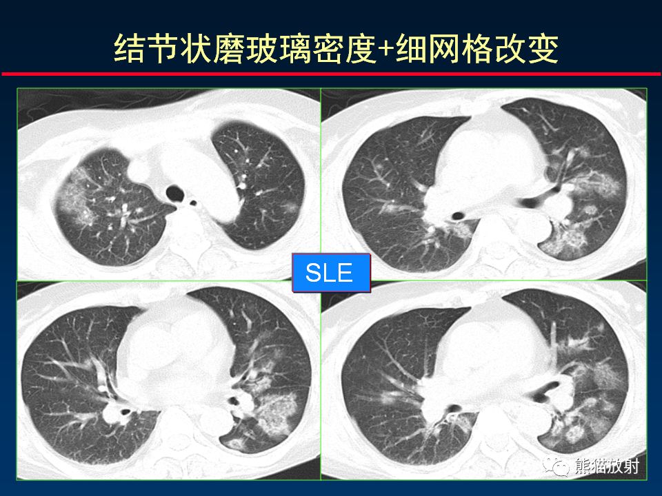 【PPT】正确判读肺间质改变的基本CT表现