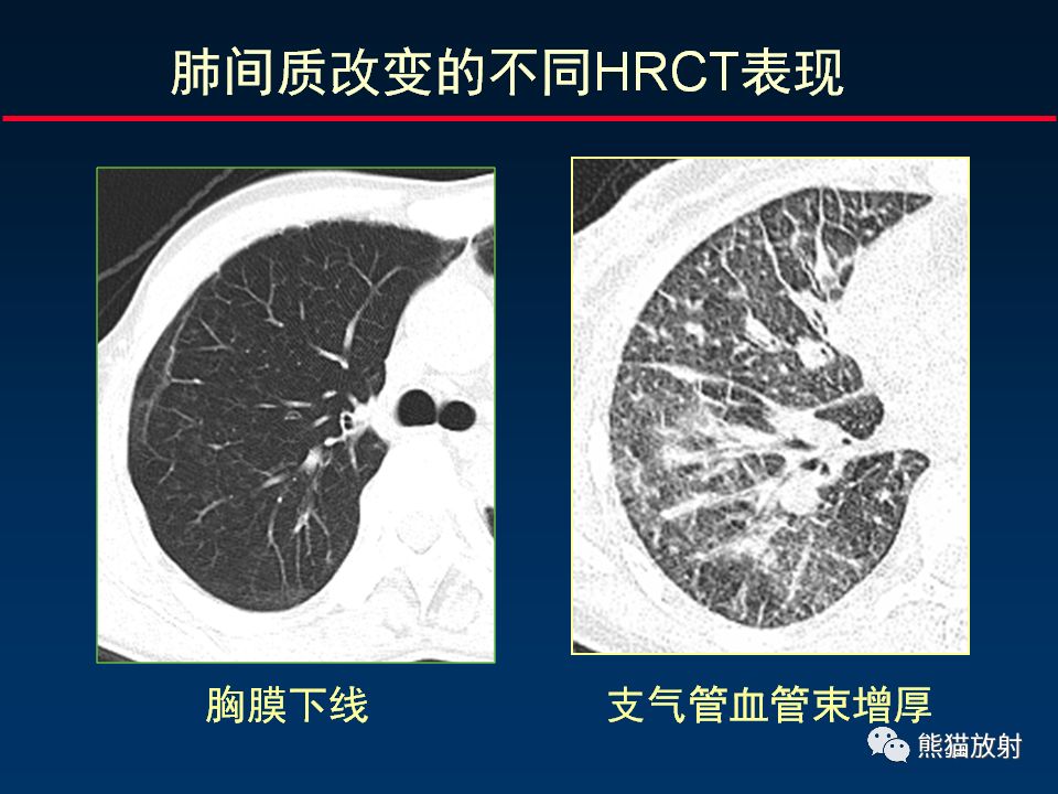 【PPT】正确判读肺间质改变的基本CT表现