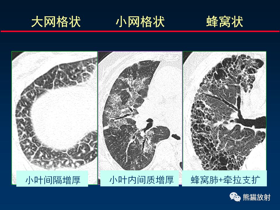 【PPT】正确判读肺间质改变的基本CT表现