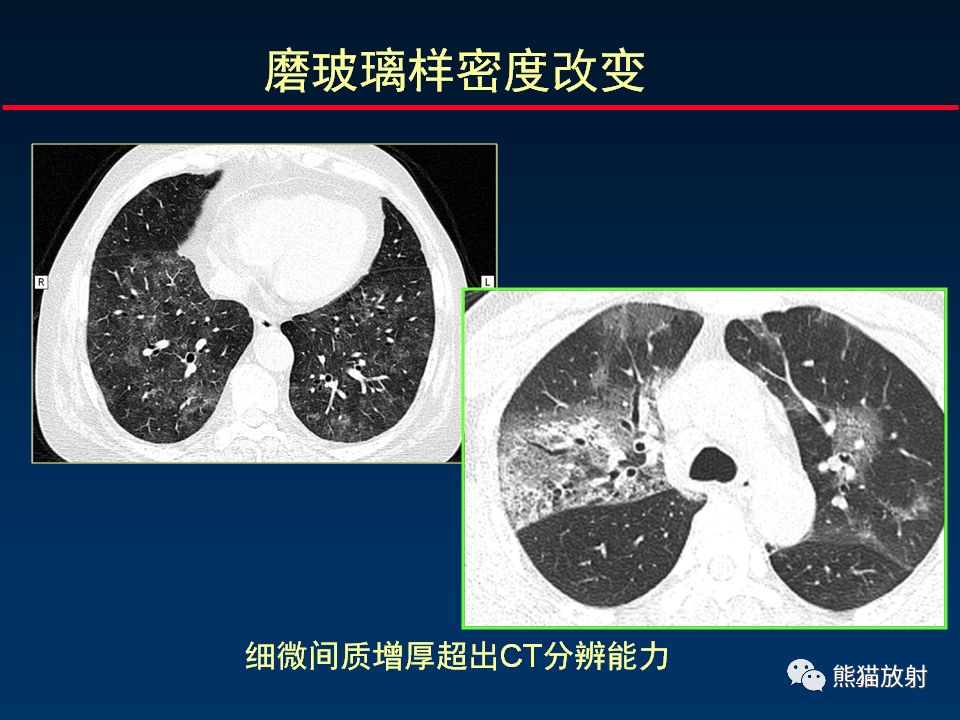 【PPT】正确判读肺间质改变的基本CT表现
