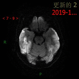 线粒体脑肌病的影像