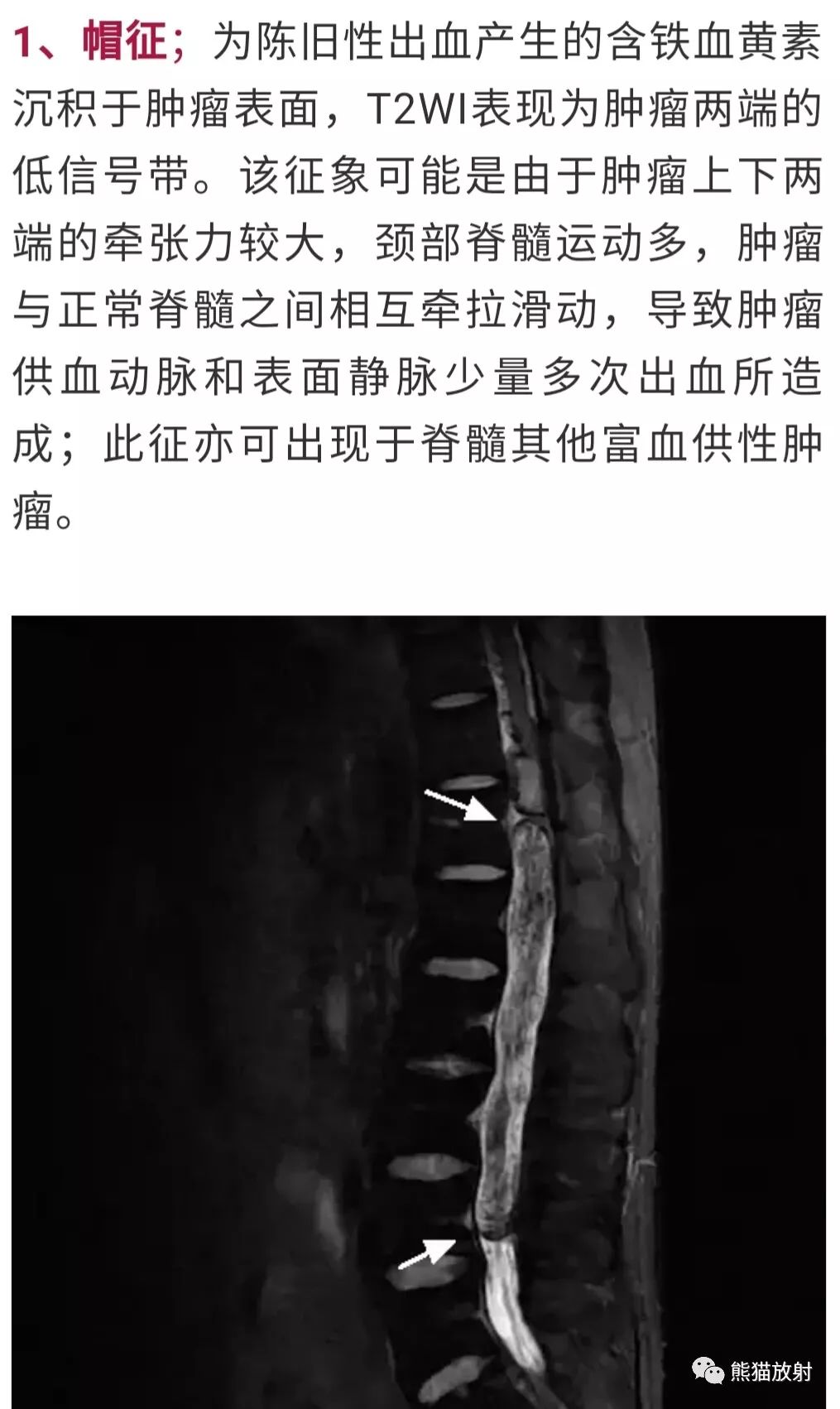 【病例】脊髓室管膜瘤1例MR影像 【病例】脊髓室管膜瘤1例MR影像