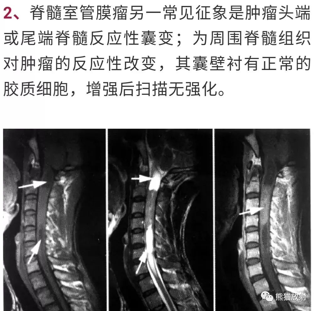 【病例】脊髓室管膜瘤1例MR影像 【病例】脊髓室管膜瘤1例MR影像
