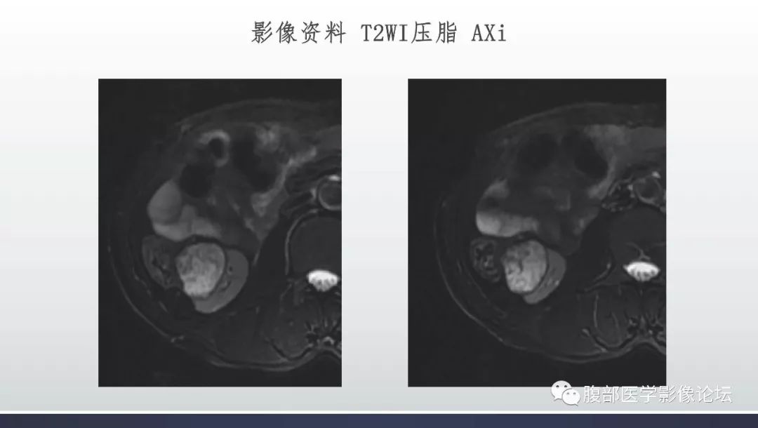 【病例】右肾乳头状肾癌1例MR