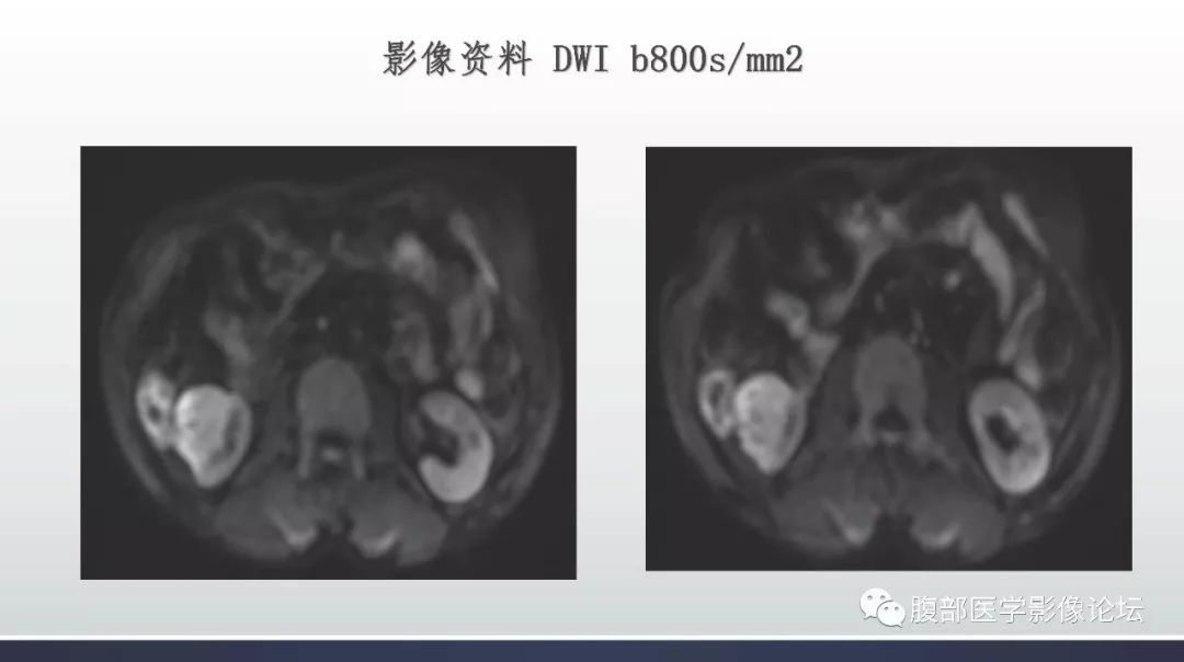 【病例】右肾乳头状肾癌1例MR