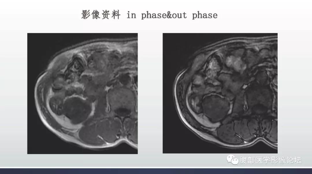 【病例】右肾乳头状肾癌1例MR