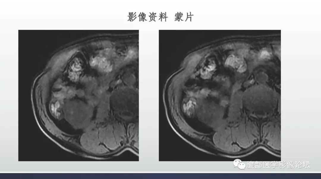 【病例】右肾乳头状肾癌1例MR