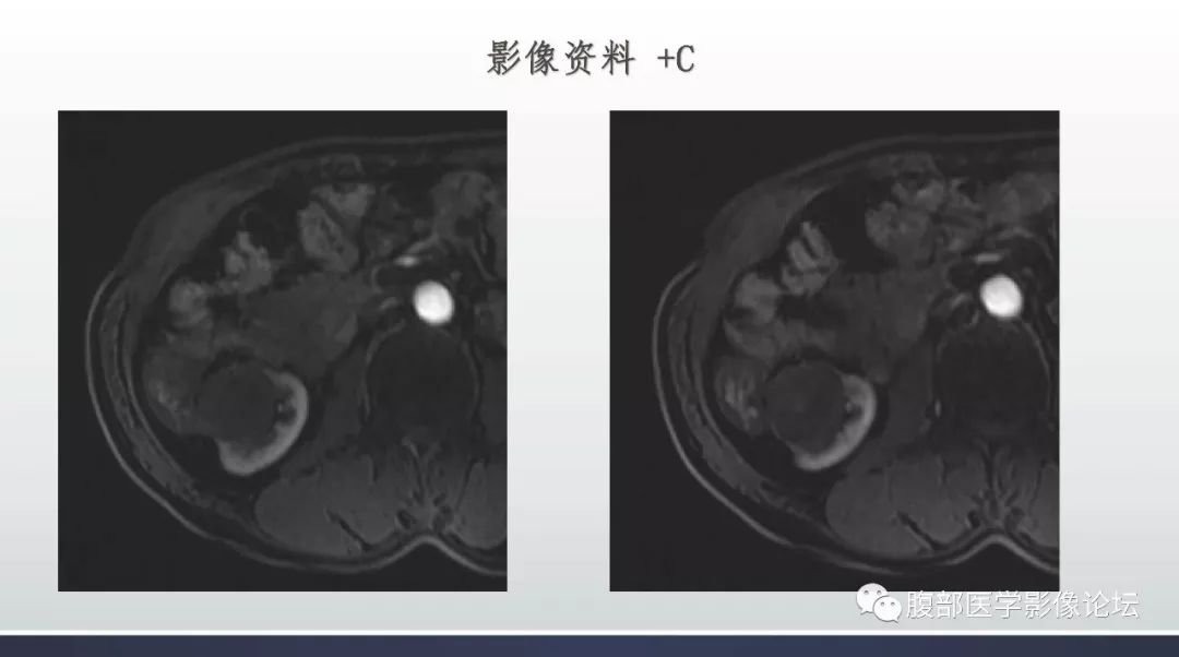 【病例】右肾乳头状肾癌1例MR