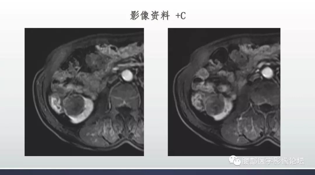 【病例】右肾乳头状肾癌1例MR