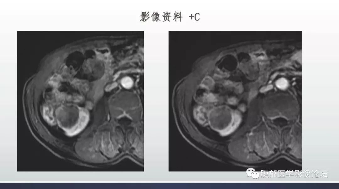 【病例】右肾乳头状肾癌1例MR