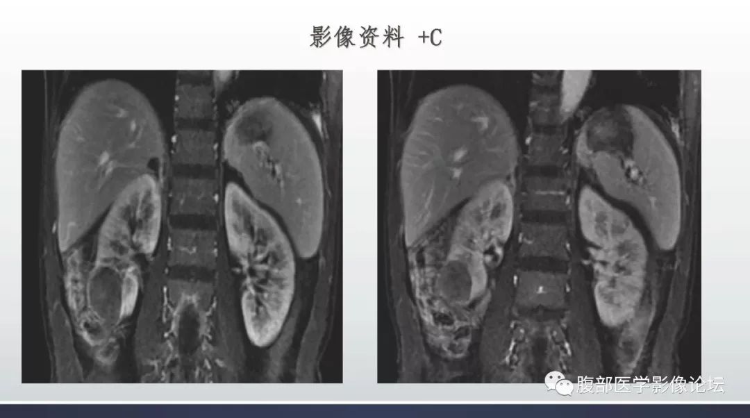 【病例】右肾乳头状肾癌1例MR