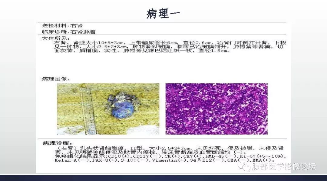 【病例】右肾乳头状肾癌1例MR