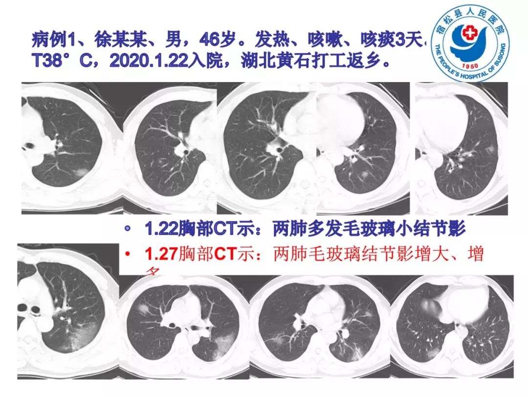 【PPT】(来自一个县医院的12例)我院新型冠状病毒肺炎特点