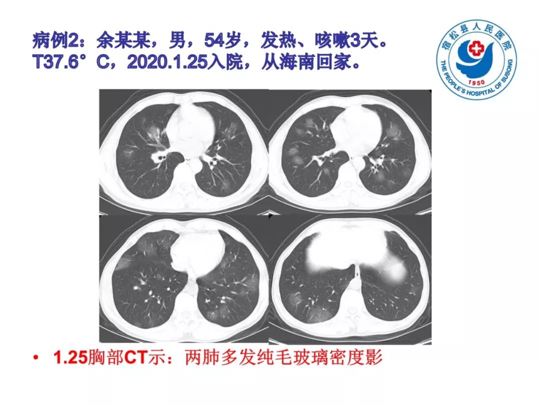 【PPT】(来自一个县医院的12例)我院新型冠状病毒肺炎特点