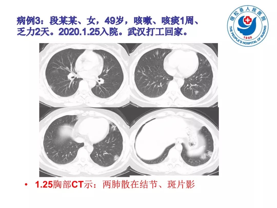 【PPT】(来自一个县医院的12例)我院新型冠状病毒肺炎特点